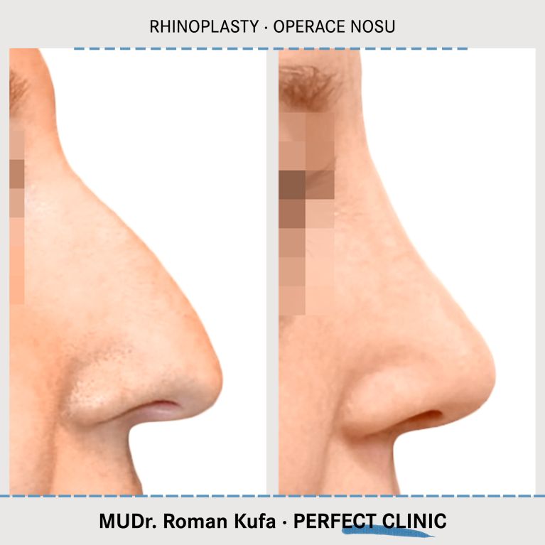 Rhinoplastika