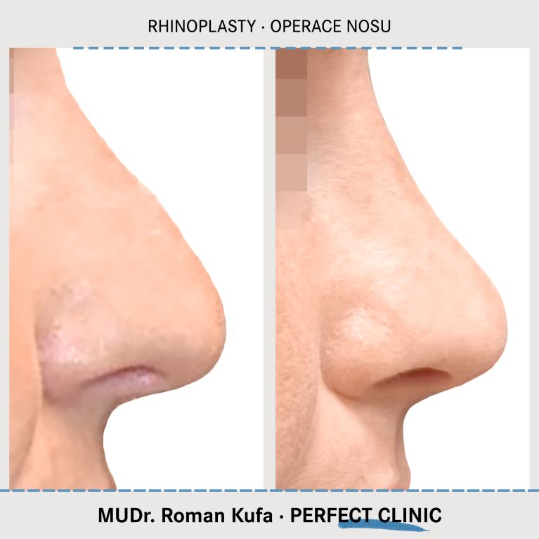 Rhinoplastika