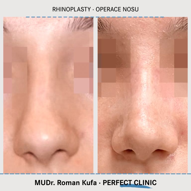 Rhinoplastika