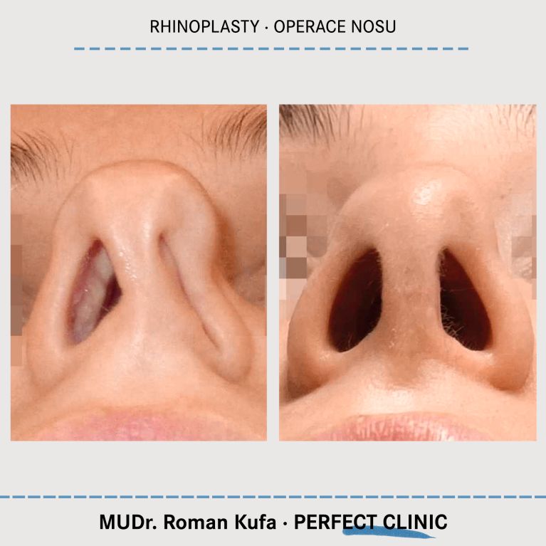 Rhinoplastika