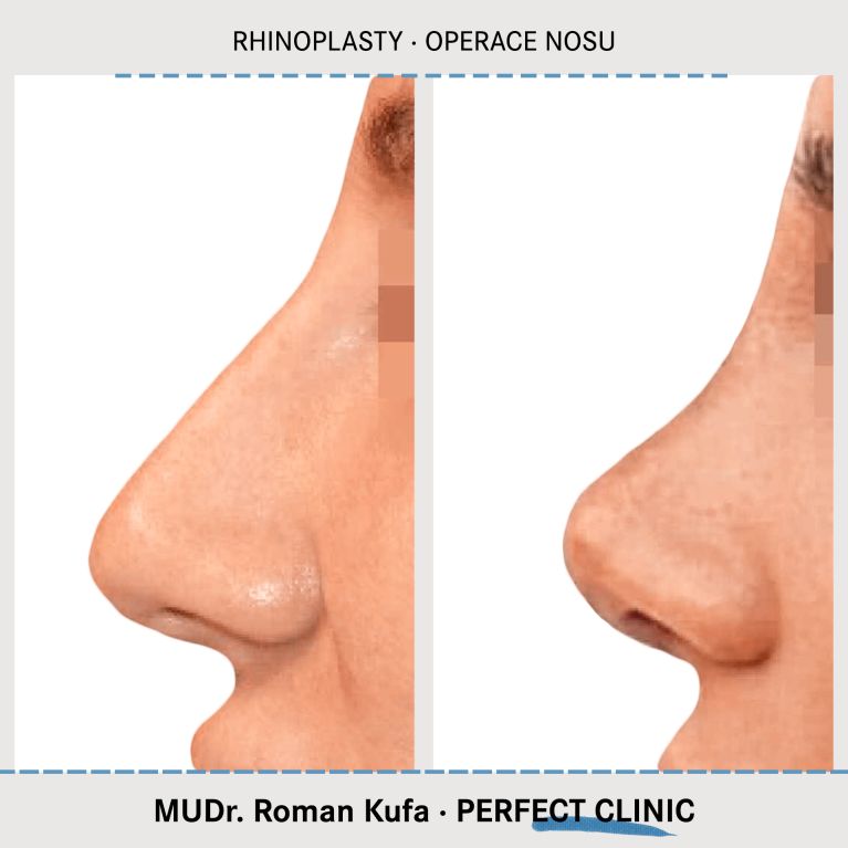 Rhinoplastika