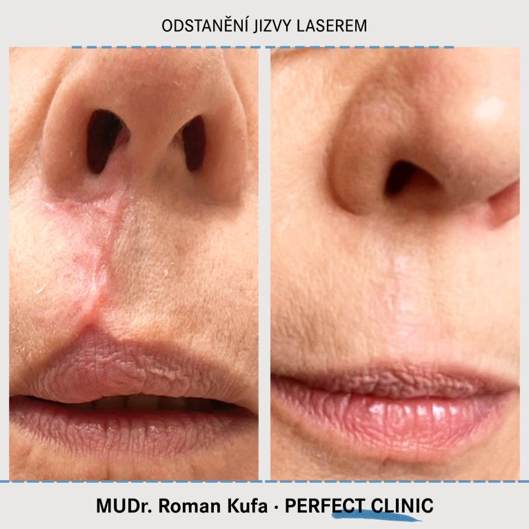 Laserové odstranění jizev