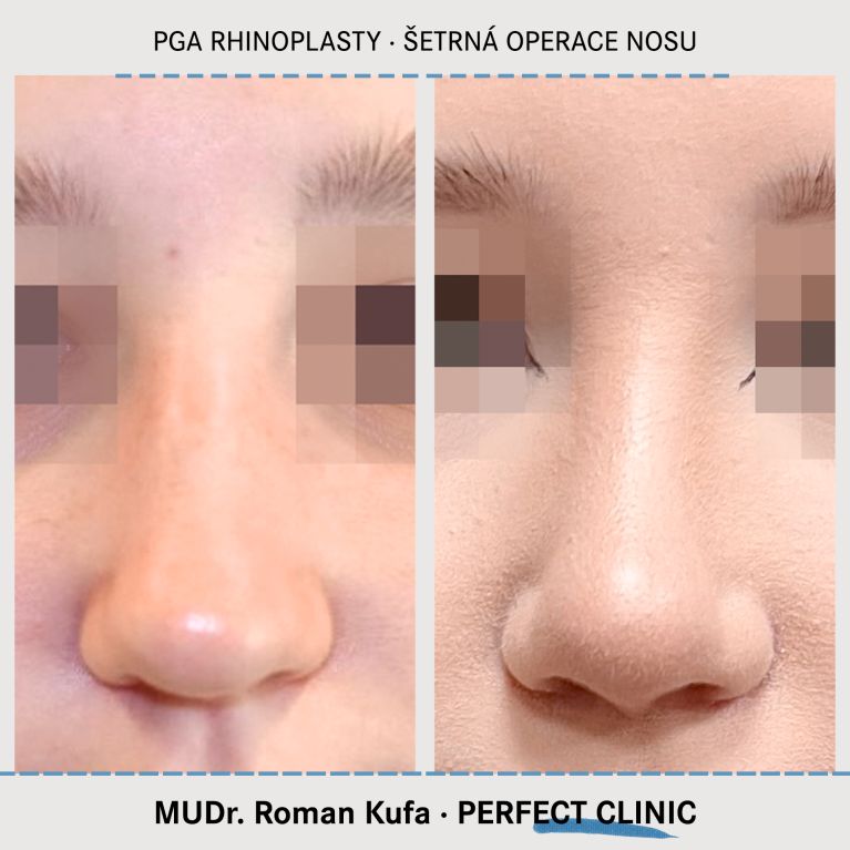 PGA Rhinoplasty