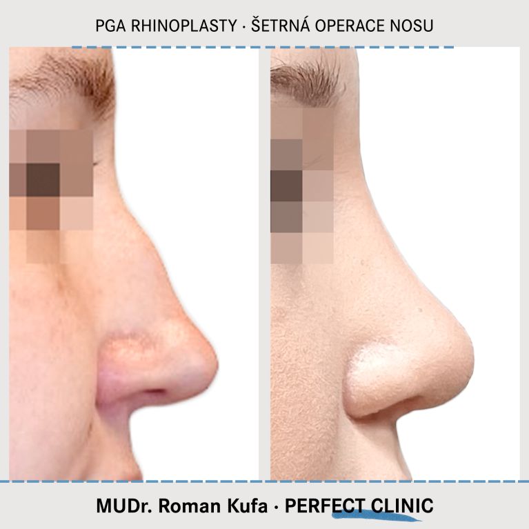 PGA Rhinoplasty