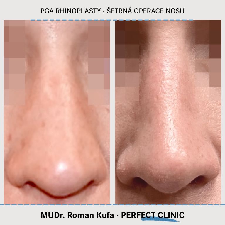 PGA Rhinoplasty