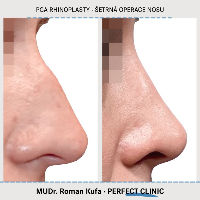 PGA Rhinoplasty