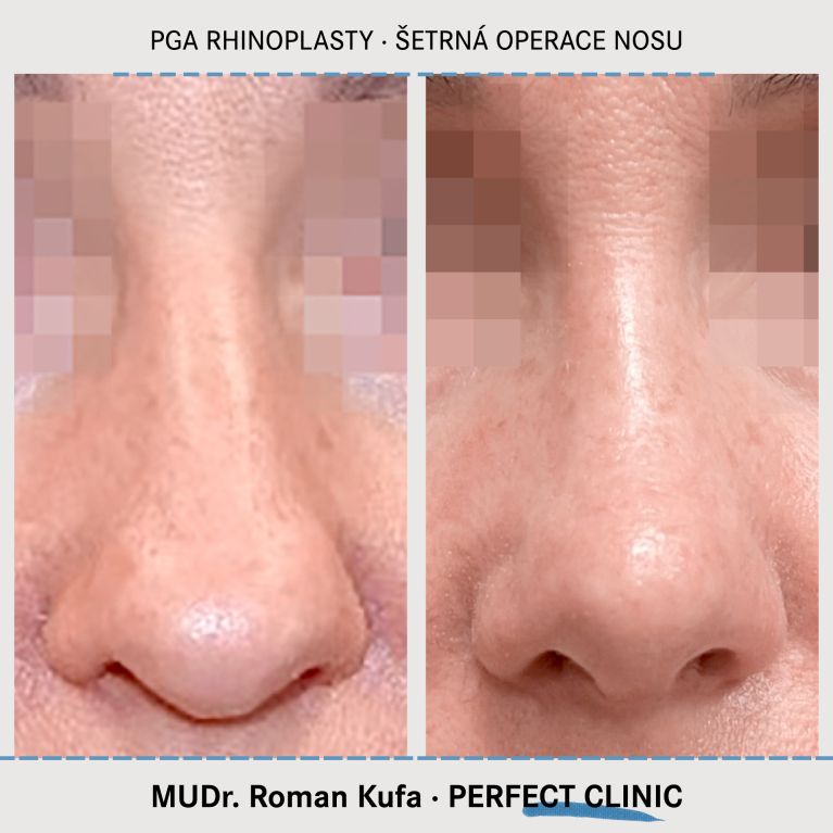 PGA Rhinoplasty