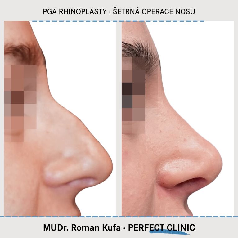 PGA Rhinoplasty
