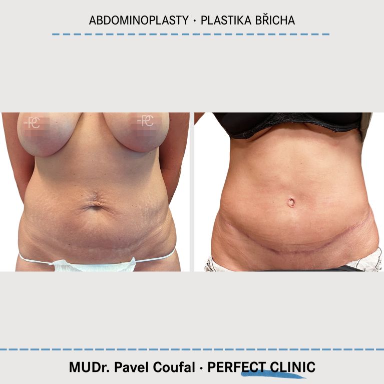 Abdominoplastika