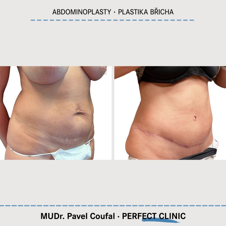 Abdominoplastika