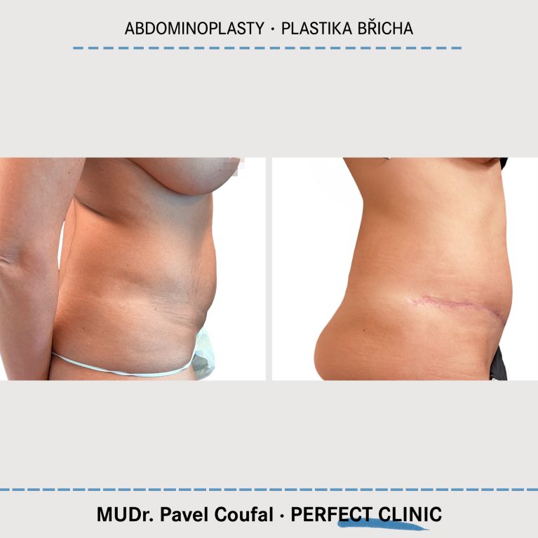 Abdominoplastika