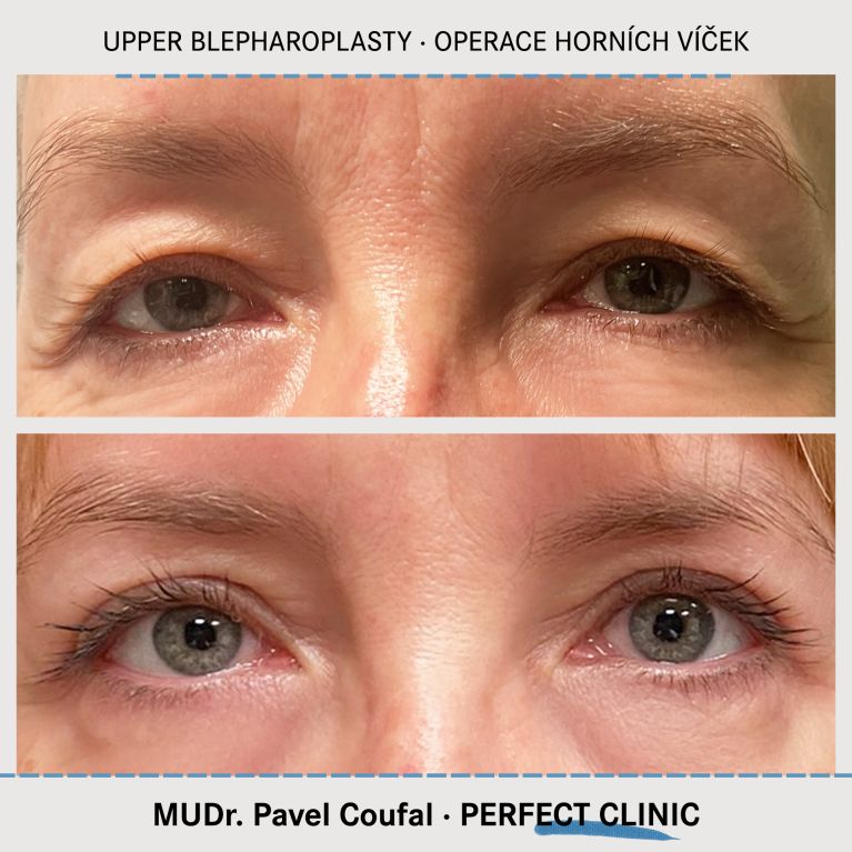 Operace horních víček