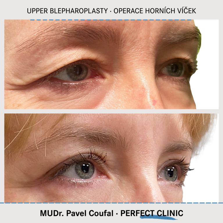 Operace horních víček