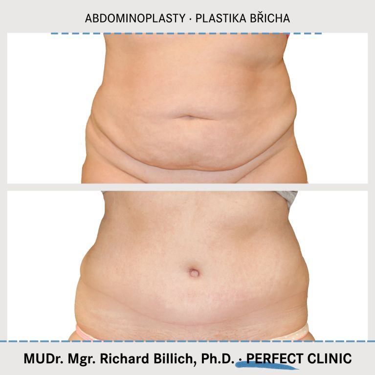 Abdominoplasty