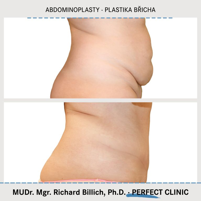Abdominoplasty