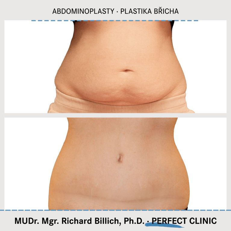 Abdominoplasty