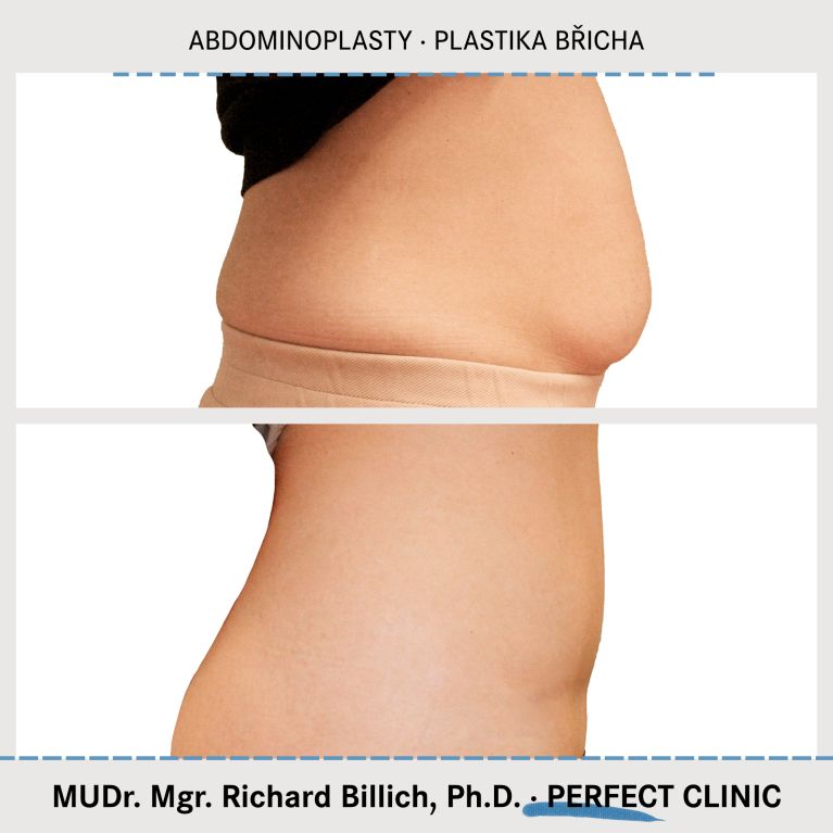 Abdominoplasty