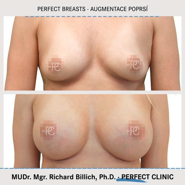 Perfect Breasts