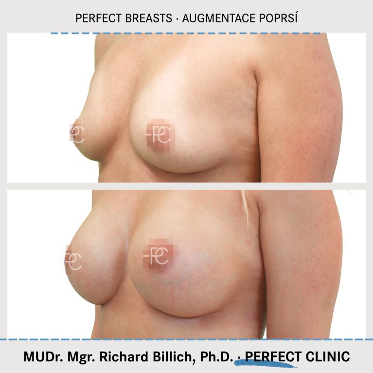 Perfect Breasts