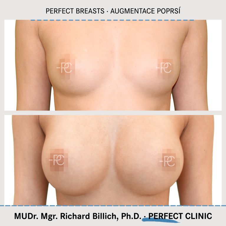 Augmentace poprsí
