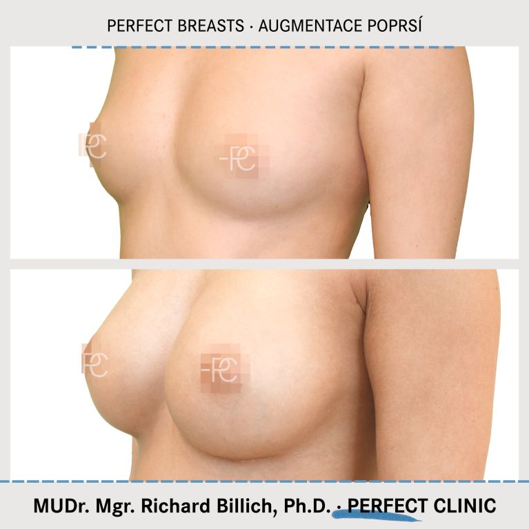 Augmentace poprsí