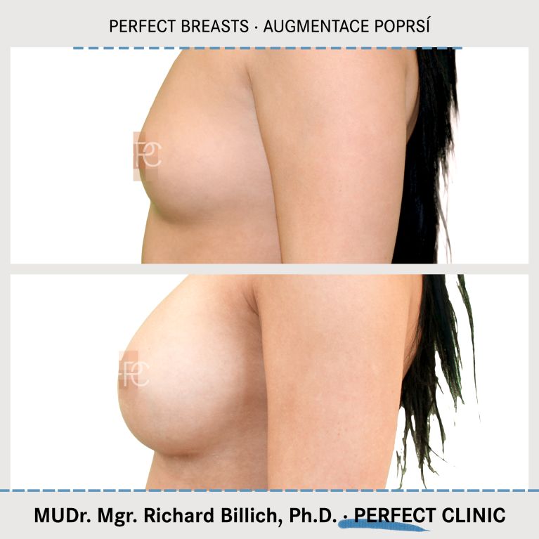 Augmentace poprsí