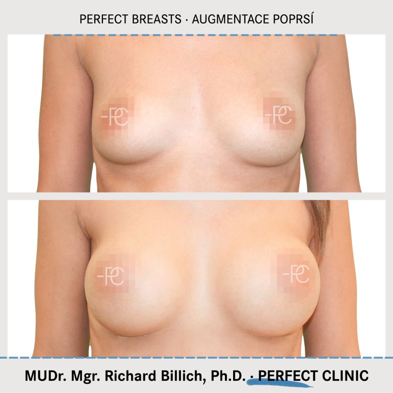 Augmentace poprsí