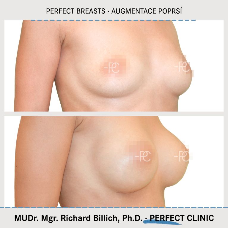 Augmentace poprsí