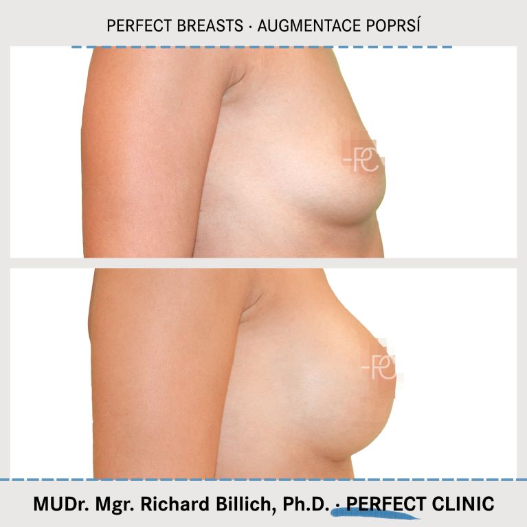 Augmentace poprsí