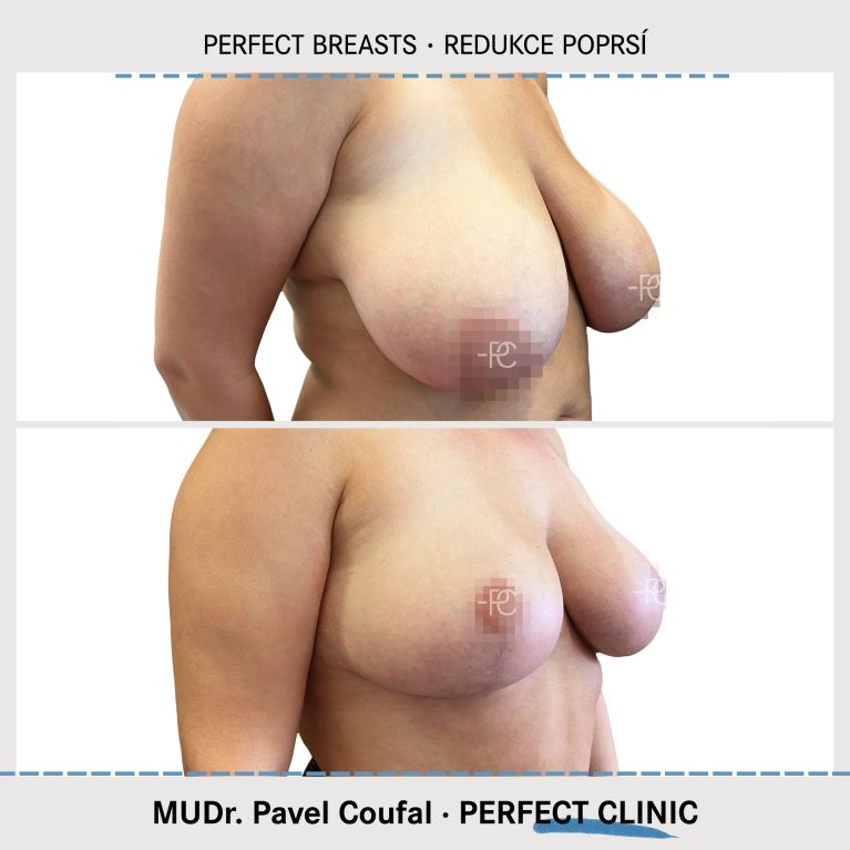 Zmenšení prsou