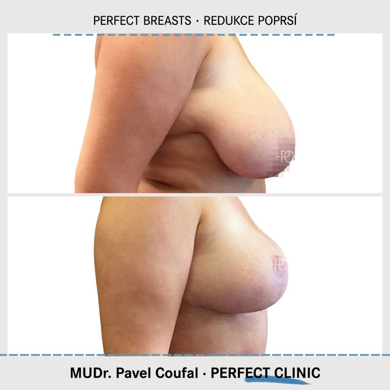 Zmenšení prsou