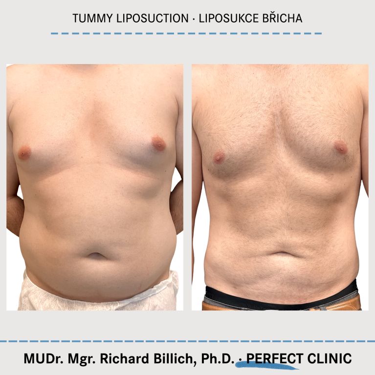 Tummy liposuction