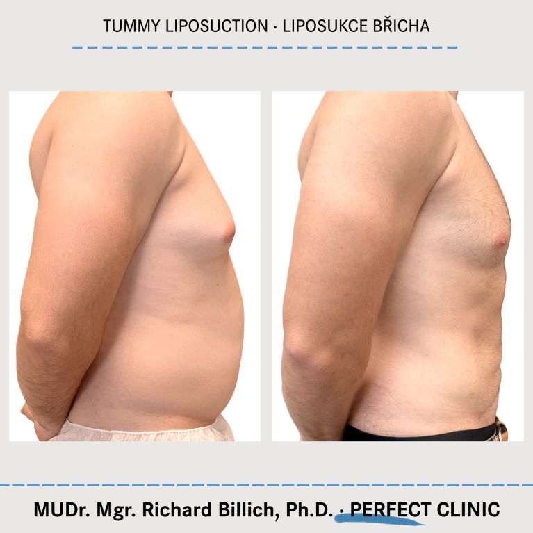 Tummy liposuction