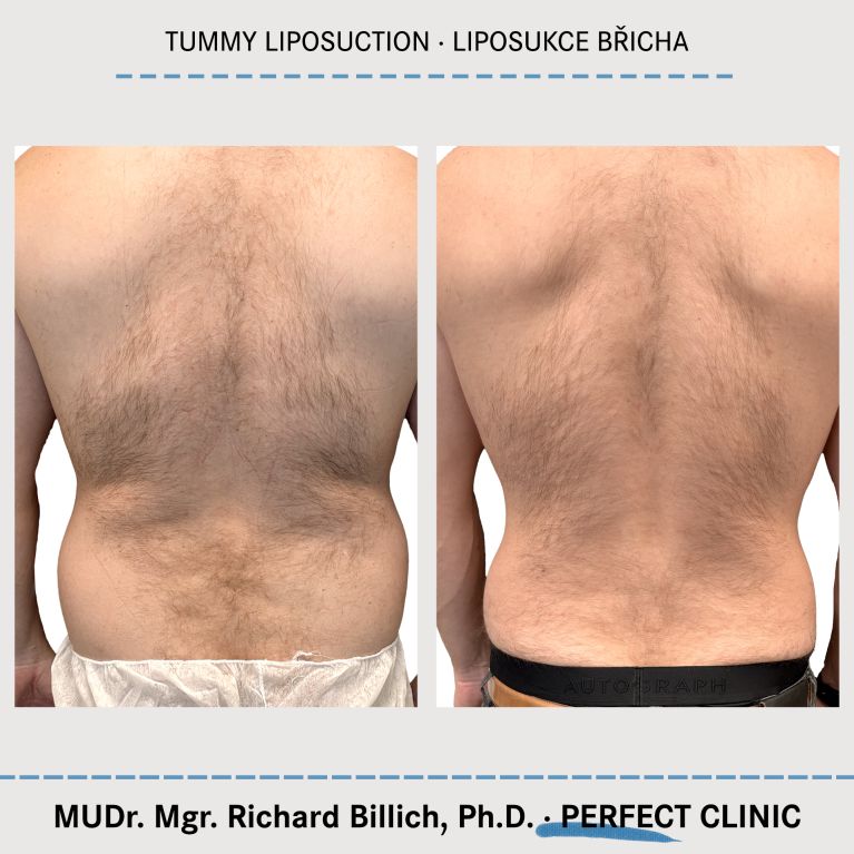 Tummy liposuction