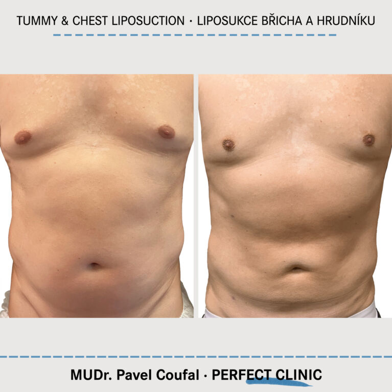 Tummy & Chest Liposuction