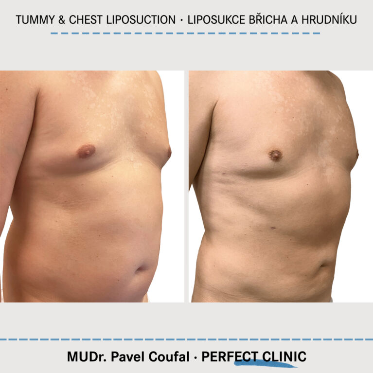 Tummy & Chest Liposuction