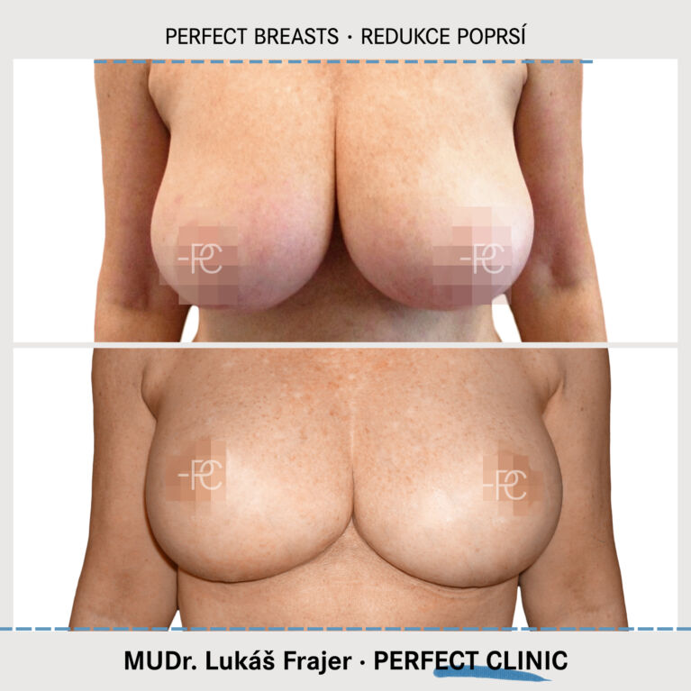 Zmenšení prsou