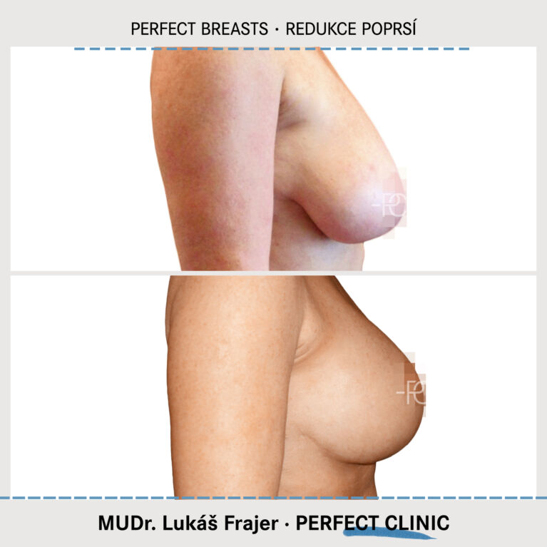 Zmenšení prsou