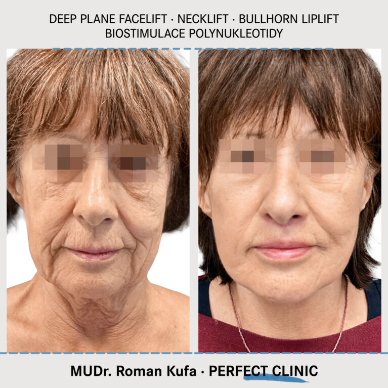 Facelift • Necklift • Liplift • Biostimulace