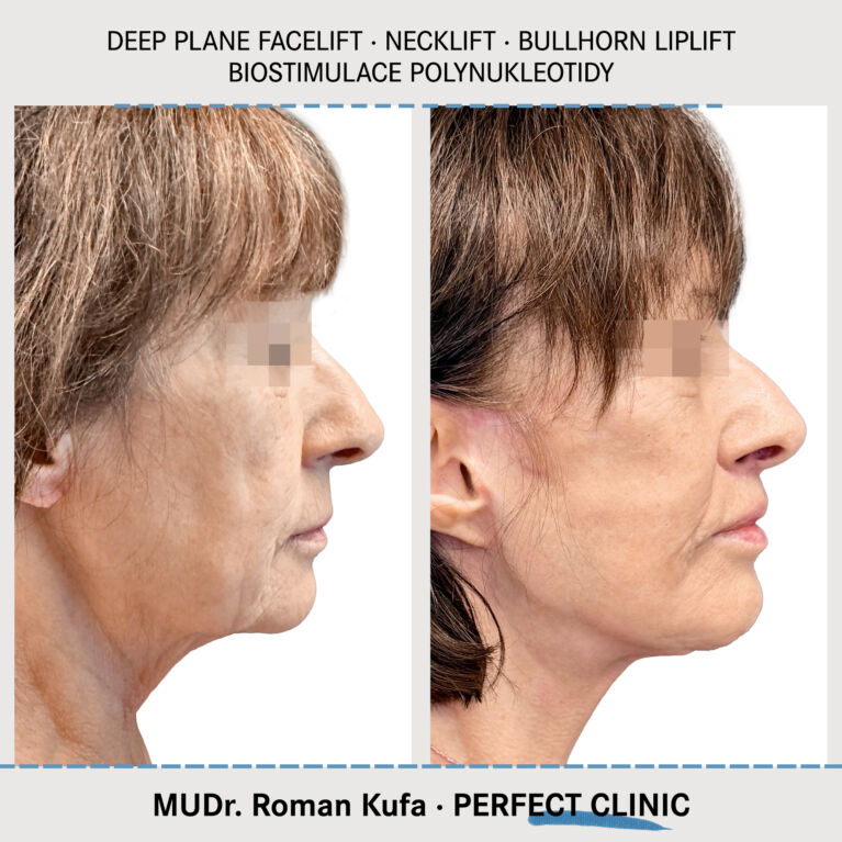 Facelift • Necklift • Liplift • Biostimulace