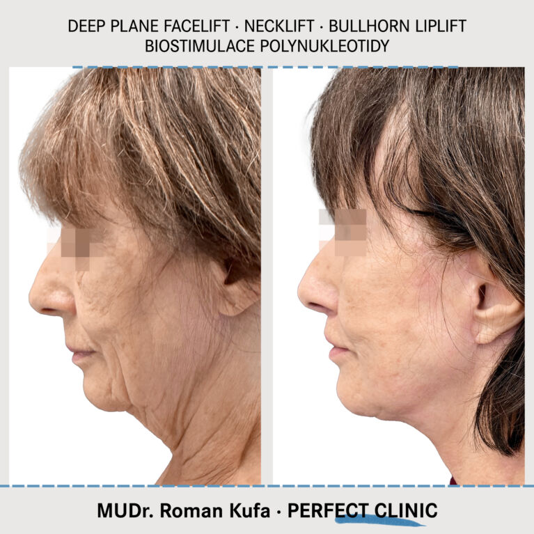 Facelift • Necklift • Liplift • Biostimulace