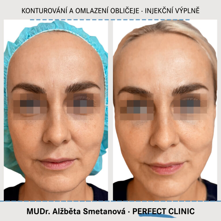 Konturováni a omlazení obličeje