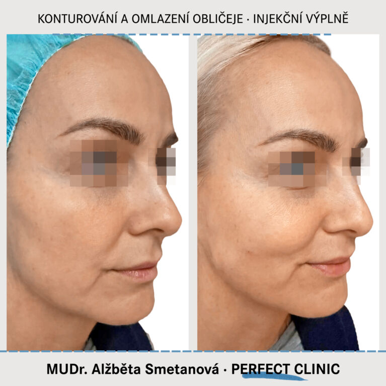 Konturováni a omlazení obličeje