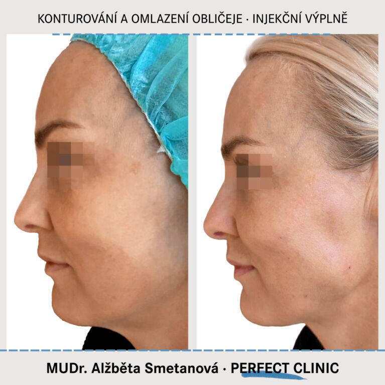 Konturováni a omlazení obličeje
