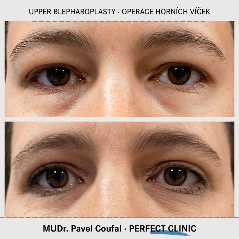 Operace horních víček
