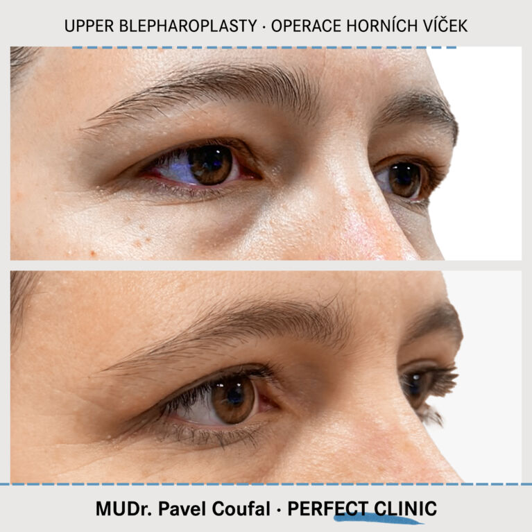 Operace horních víček