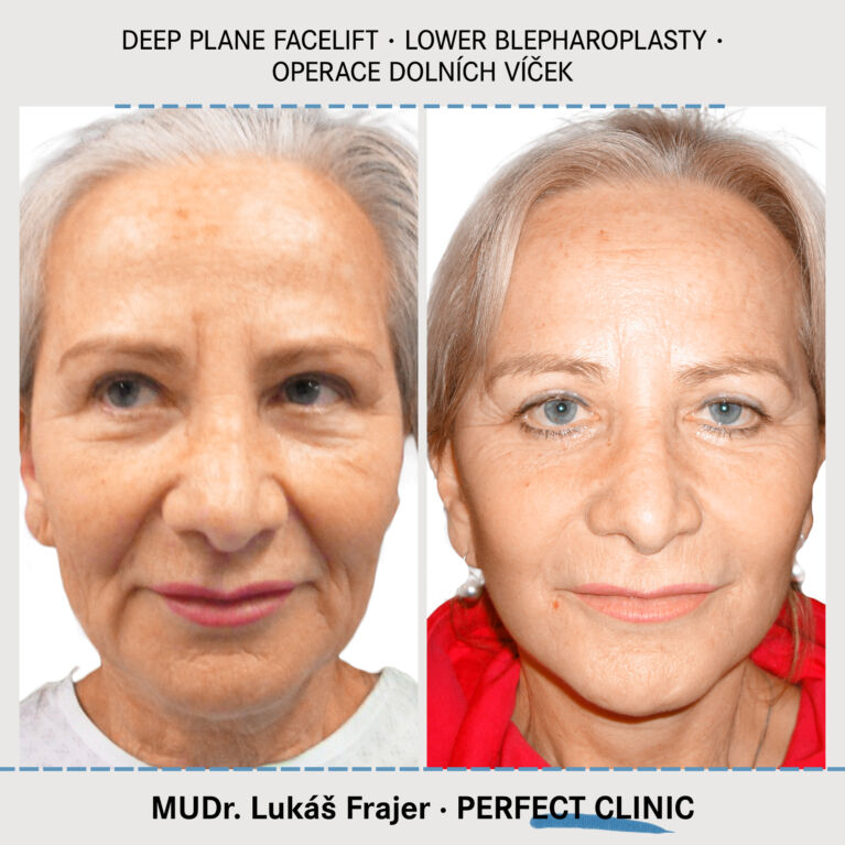 Facelift & Blepharoplasty
