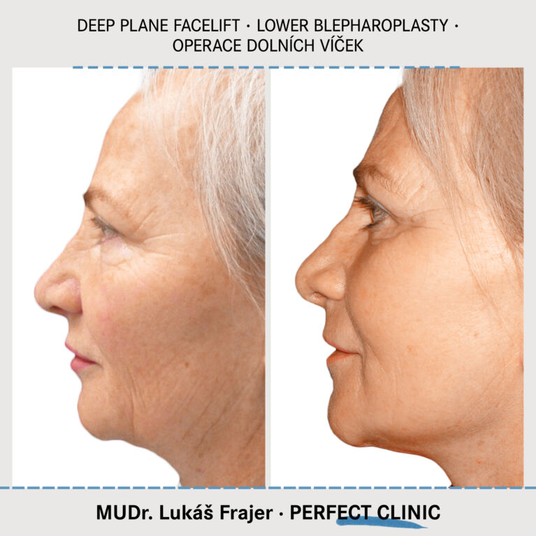 Facelift & Blepharoplasty