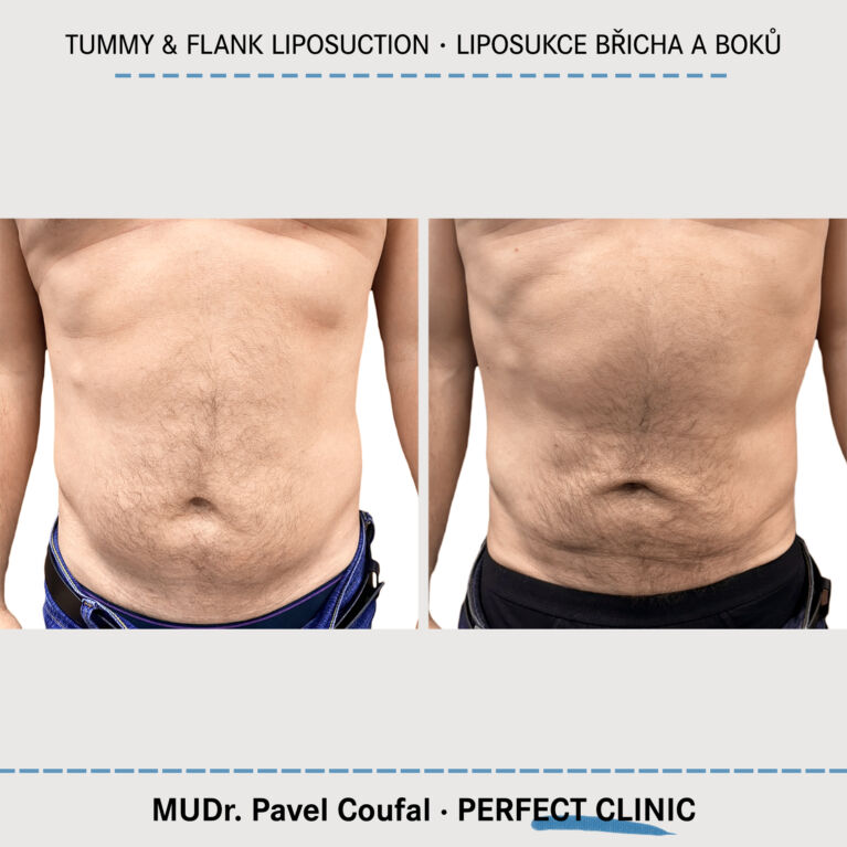 Tummy & Chest Liposuction