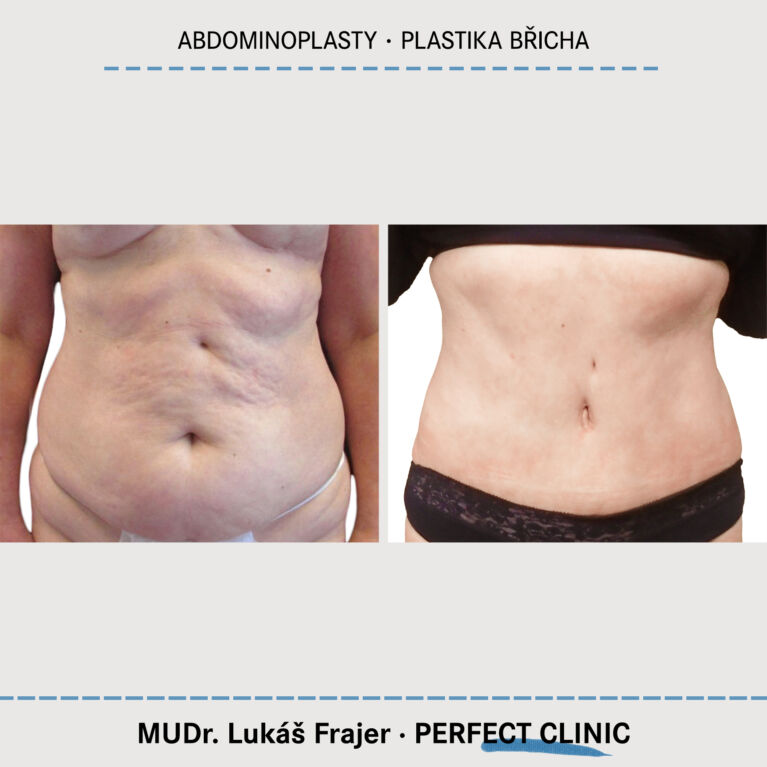 Abdominoplasty